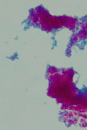 Acid-fast stain showing bright pink acid-fast bacteria against a blue background of non–acid-fast material.
