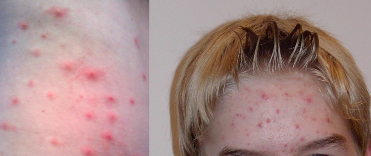 A forearm and a picture of a woman's head with bacteria on the skin. 